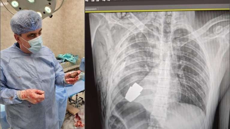 Ουκρανία: Χειροβομβίδα σφηνώθηκε στο στήθος στρατιώτη χωρίς να εκραγεί - Οι γιατροί κατάφεραν να την αφαιρέσουν