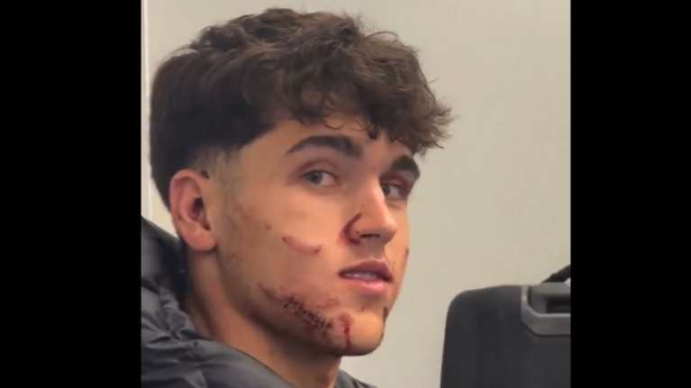 Μπαρτσελόνα: Σοκάρουν οι φωτογραφίες του Κουμπαρσί μετά την κλωτσιά στο πρόσωπο