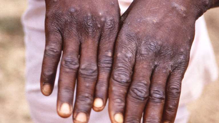 Παγκόσμιος συναγερμός για την ευλογιά των πιθήκων: Εξαπλώνεται στην Ευρώπη - Έκτακτη συνεδρίαση του Π.Ο.Υ