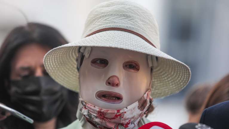 Επίθεση με βιτριόλι: Αύριο καταθέτουν οι γιατροί της Ιωάννας - &quot;Μόνο από τη γάμπα και κάτω δεν έχει καεί&quot;