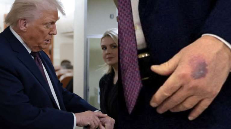 Τι συμβαίνει με την υγεία του Τραμπ: Η μελανιά στο χέρι του και η εξήγηση στους δημοσιογράφους [βίντεο]