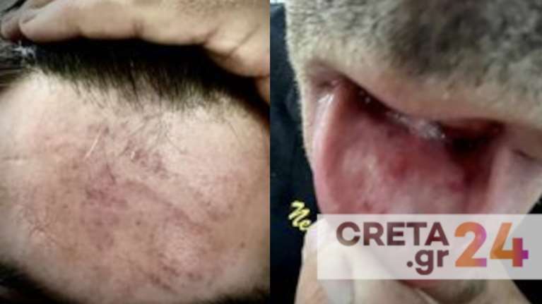 Κρήτη: Άγριος ξυλοδαρμός αστυνομικού από κτηνοτρόφο και συγγενείς του για θέση στάθμευσης