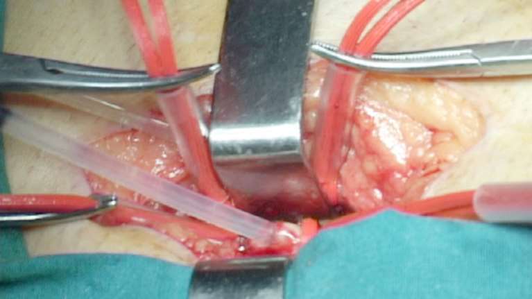 Εξοργιστικό: Γιατροί ξέχασαν στην κοιλιά ασθενούς σπάτουλα - Αποζημίωση 64.500 ευρώ στην άτυχη γυναίκα