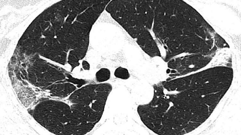 Κορονοϊός: Δείτε τι συνέβη στους πνεύμονες Κινέζου ασθενούς που νόσησε και πέθανε