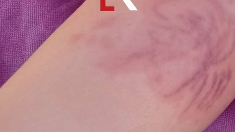 Φθιώτιδα: Σοβαρά εγκαύματα σε 4χρονη από θαλάσσια ανεμώνη [εικόνες]