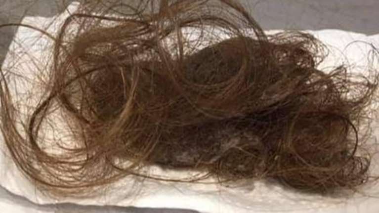 &quot;Αυτό αντίκρυσα όταν πήγα να χτενιστώ&quot;: Συγκλονίζουν οι μαρτυρίες ασθενών με long covid