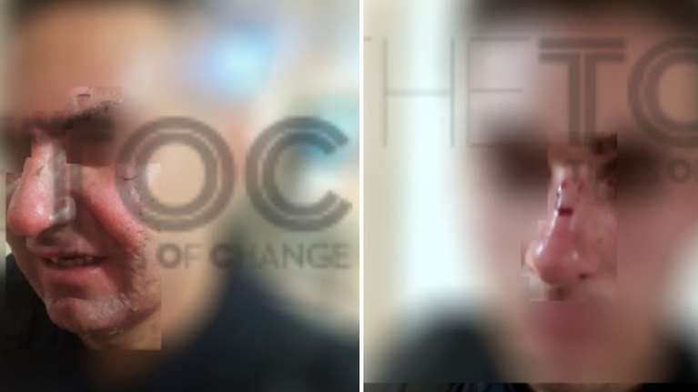 Επεισόδια στο Σύνταγμα: Φωτογραφίες - σοκ από τους τραυματίες αστυνομικούς - Δέχθηκαν επίθεση με μολότοφ σε ευθεία βολή