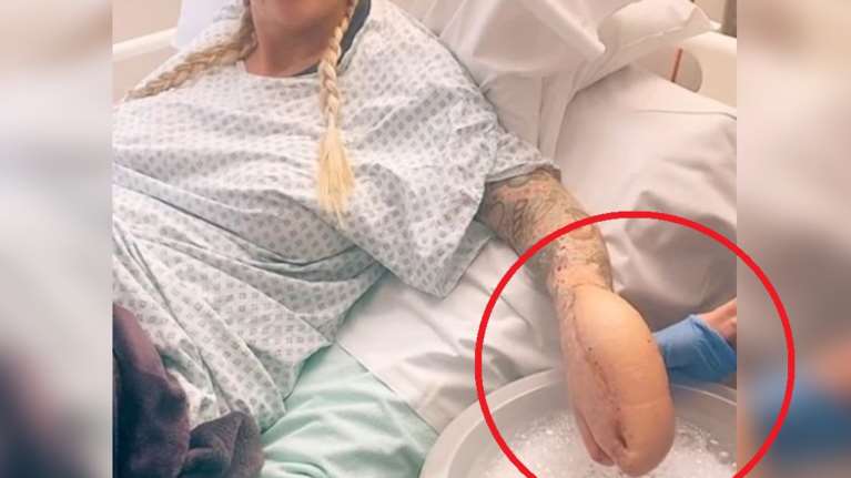 Η γυναίκα με το χέρι-καρχαρία: Οι γιατροί το ακρωτηρίασαν και το έραψαν μέσα στην κοιλιά - Βίντεο