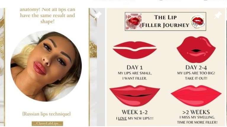 Παράνομο μποτοξάδικο &quot;Τα κλασάτα χείλη&quot; - Με απαγορευμένα και επικίνδυνα προϊόντα