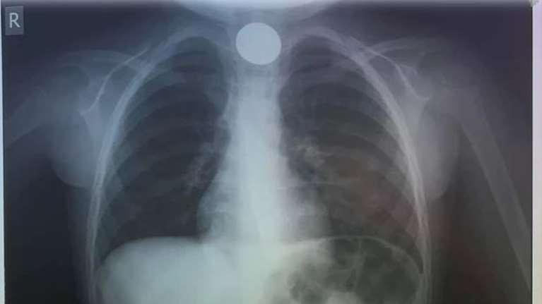 Σώθηκε από θαύμα: Κέρμα σφηνώθηκε στον λαιμό 4χρονου στην Κρήτη