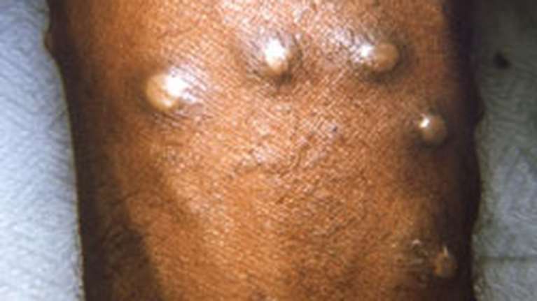 Ευλογιά των πιθήκων: Στην Ισπανία ο πρώτος θάνατος στην Ευρώπη - Νεκρός 41χρονος και στη Βραζιλία