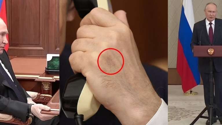 Έχει βάση η δήλωση του Ζελένσκι ότι ο Πούτιν "θα πεθάνει σύντομα"; Η μελανιά στο χέρι, το τρέμουλο στο πόδι, τα μπερδεμένα λόγια