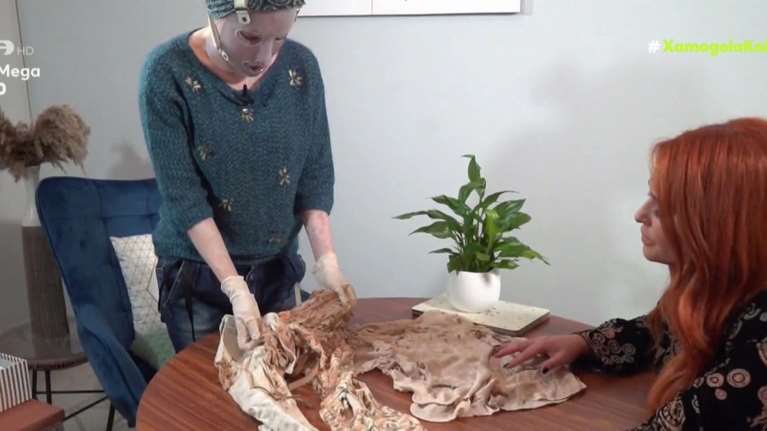 Συγκλονίζει η Ιωάννα Παλιοσπύρου: Δείχνει τα σημάδια και τα κατεστραμμένα ρούχα από την επίθεση με βιτριόλι [εικόνες - βίντεο]