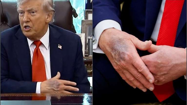 Ανησυχία και ερωτήματα προκαλεί τεράστια μελανιά στο χέρι του Τραμπ: &quot;Είναι από τις πολλές χειραψίες&quot; λέει αλλά δεν πείθει