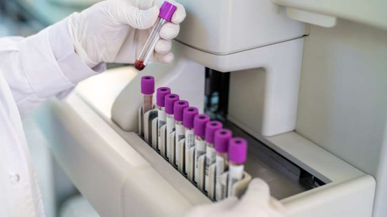 Πότε πρέπει να κάνουμε τις πρώτες εξετάσεις για χοληστερίνη και κάθε πότε να τις επαναλαμβάνουμε