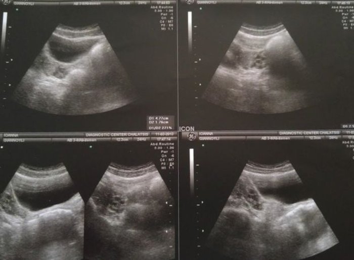 Η εξομολόγηση μιας Ελληνίδας στο BBC: Γεννήθηκα χωρίς μήτρα,τράχηλο & κόλπο - εικόνα 3