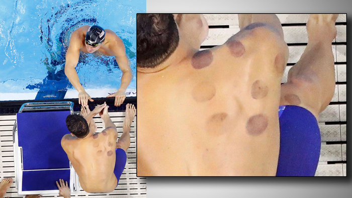 Οι μελανιές στην πλάτη του Φελπς και το ντοπάρισμα της γιαγιάς