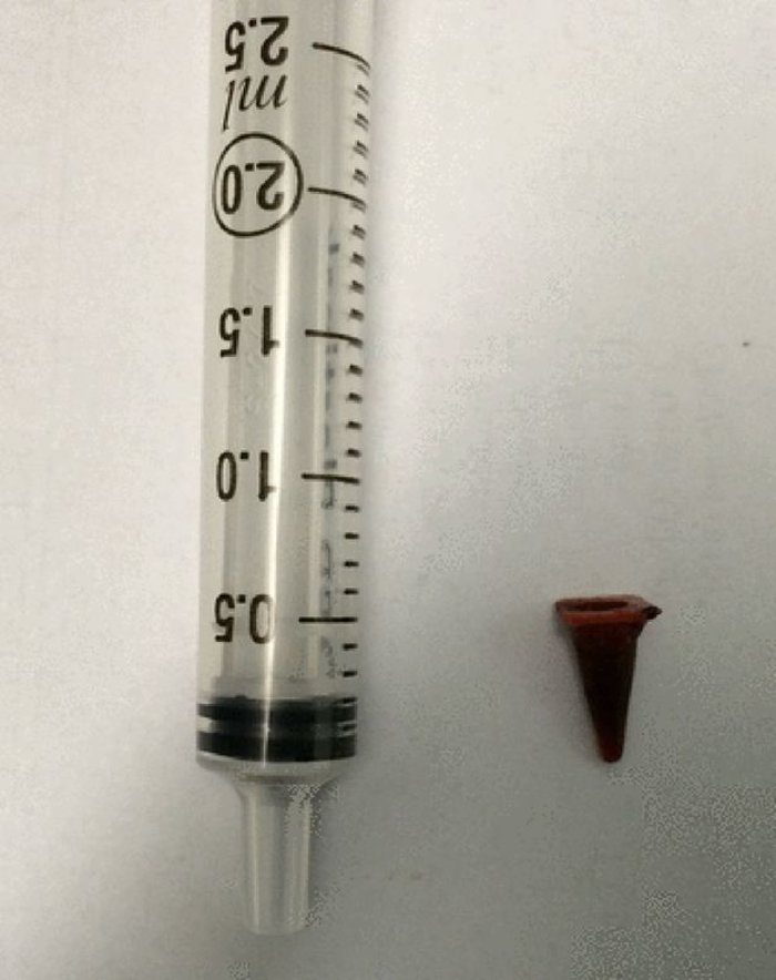 Οι γιατροί νόμιζαν ότι είχε καρκίνο, αλλά ο όγκος ήταν ένα Playmobil !