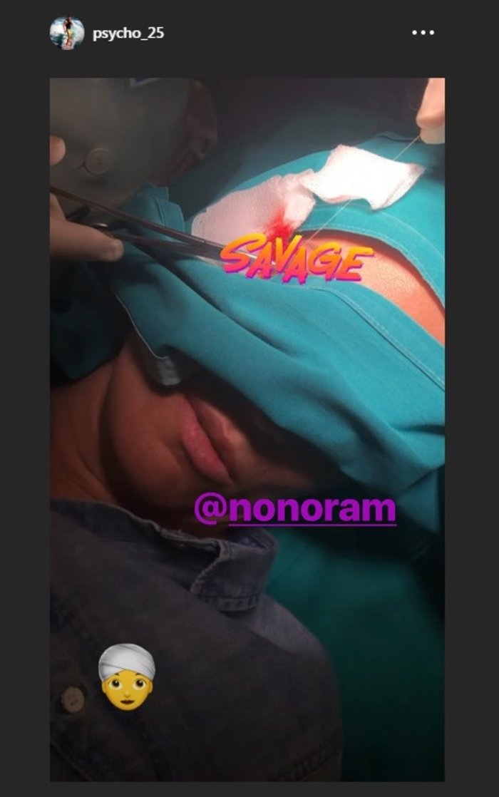 Χτύπησε η Ελεονώρα Μελέτη: Η φωτό ενώ κάνει ράμματα στο πρόσωπο [Εικόνα]